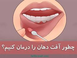 درمان آفت دهان